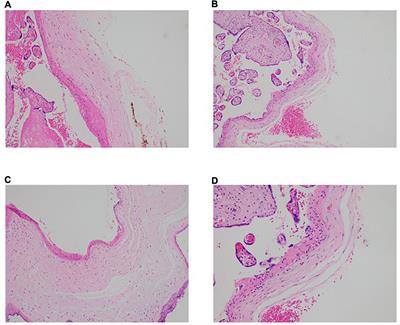 Immune and pathophysiologic profiling of antenatal coronavirus disease 2019 in the GIFT cohort: A Singaporean case-control study